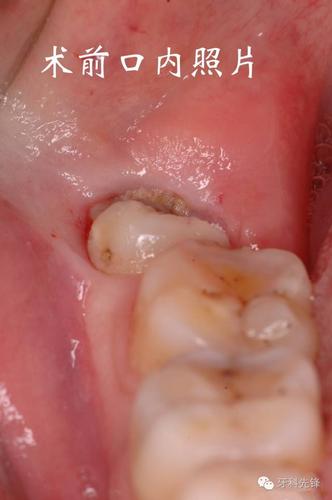 智齿高位近中阻生齿容易拔吗