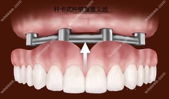 杆卡式种植覆盖义齿 可以不取吗