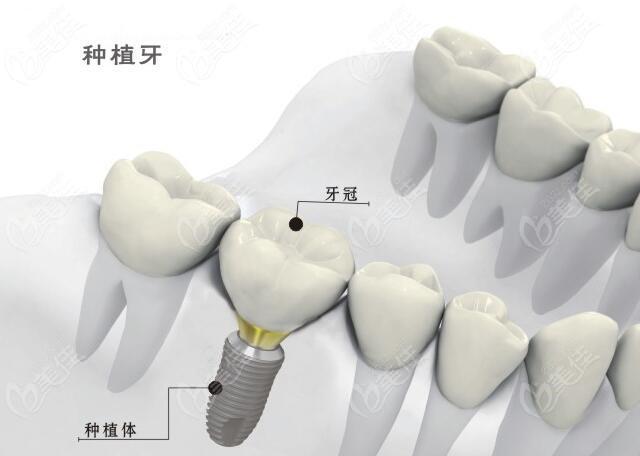 非埋入式种植牙