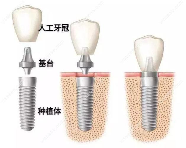 非埋入式种植牙