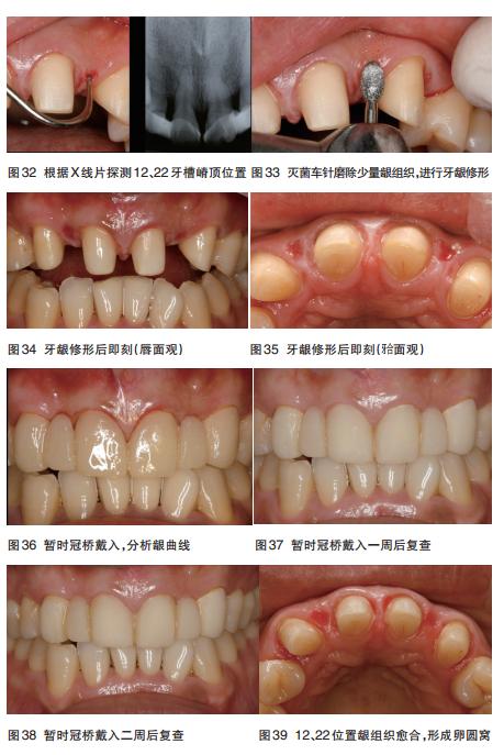 口腔固定桥修复