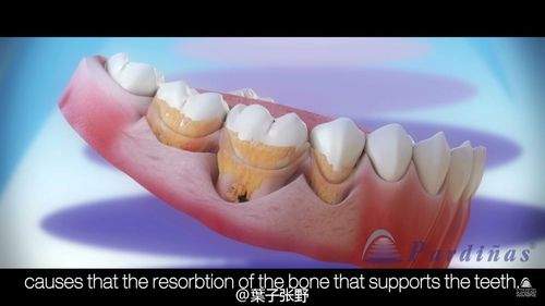 牙周袋怎么去除小窍门—牙周袋去除小窍门