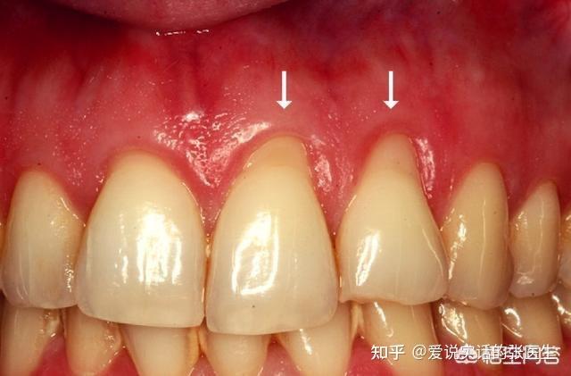 牙龈软组织增量术可以报医保吗