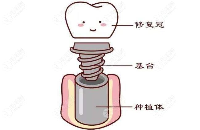 种植义齿修复的基本原则