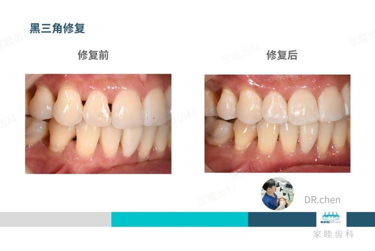 牙龈黑三角修复