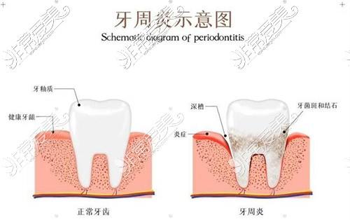 水冷激光牙周炎治疗多少钱