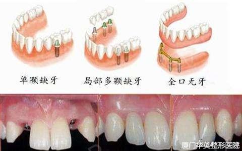 牙体修复步骤