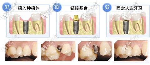种植牙二期手术解析