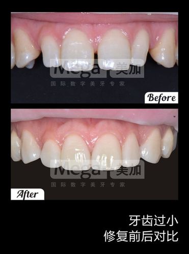 牙龈收缩可作牙贴面吗