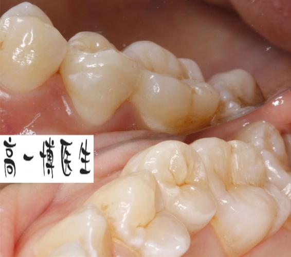 后牙牙冠修复过程视频—牙冠修复后悔了