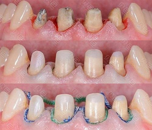 纤维桩和全瓷桩的区别