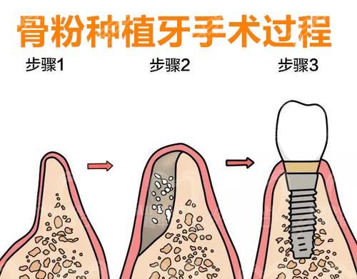 种牙前填骨粉后要肿多久