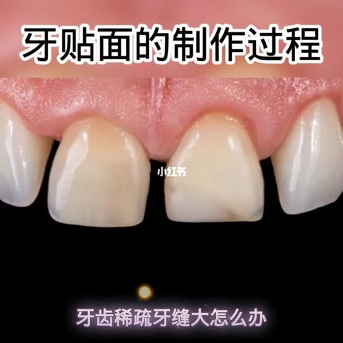 门牙牙缝大修复估计要多少钱—门牙牙缝大修复