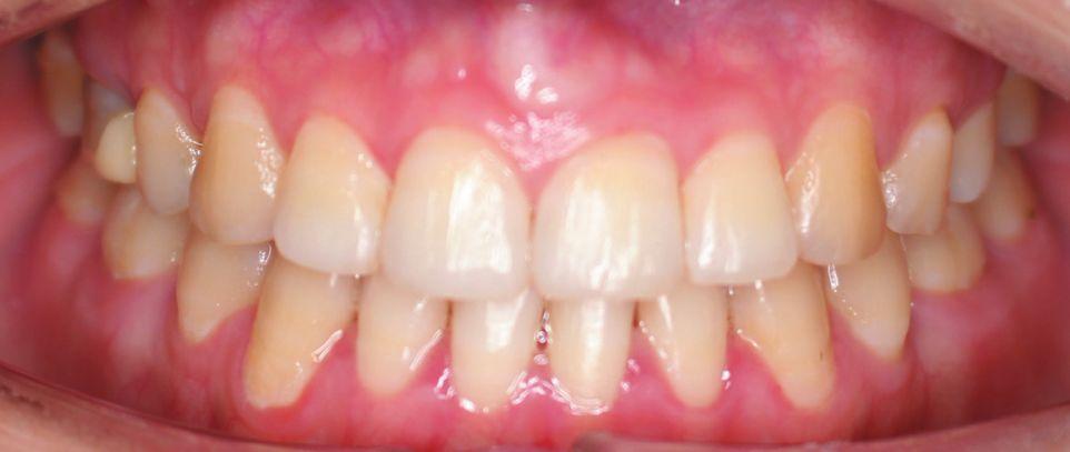 牙龈外露