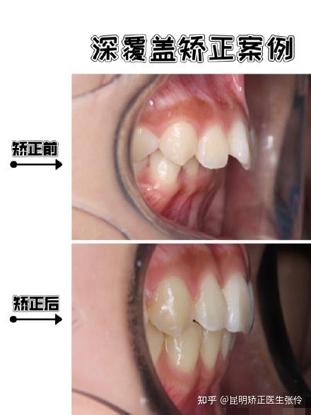 牙齿咬合深覆盖怎么矫正