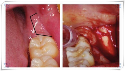 智齿冠周瓣切除手术