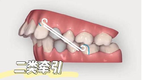 正畸牵引钩的使用方法