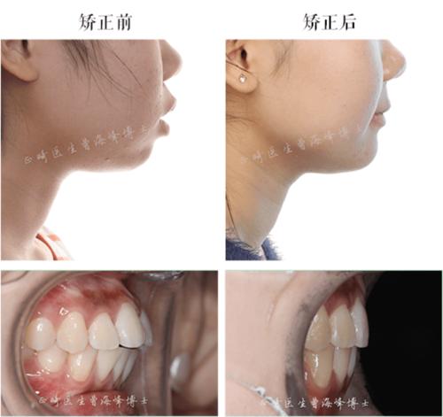 门牙前突矫正