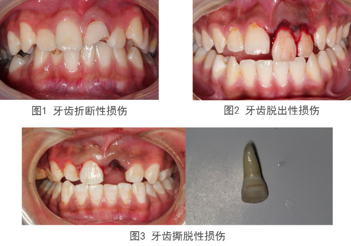 牙挫伤影响何部分