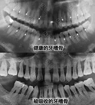 牙槽骨吸收