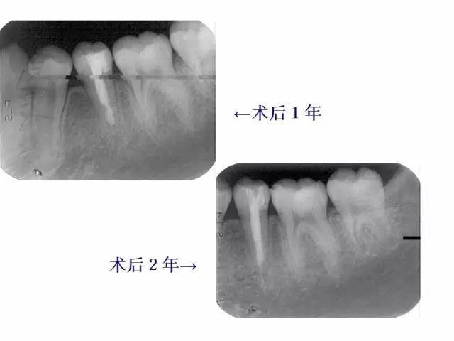 牙根尖诱导术