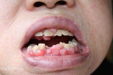 激光切除牙龈增生疼吗