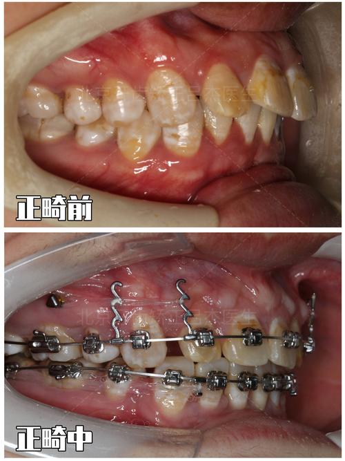 牙根部突出