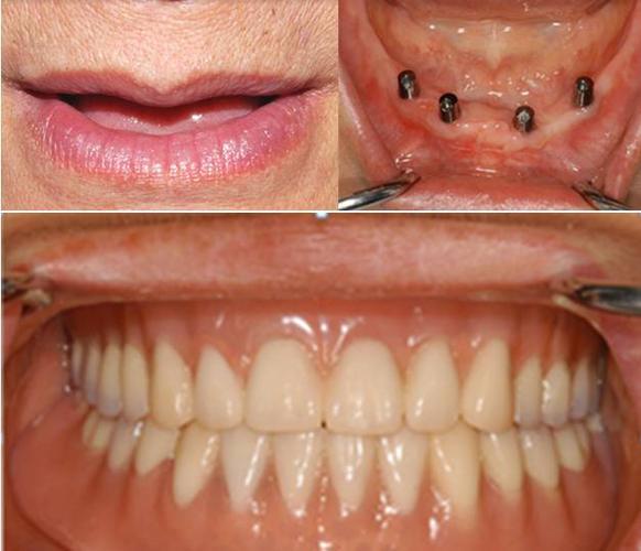 种牙微创手术后多久恢复