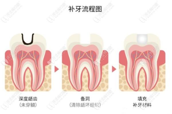 牙体修复步骤