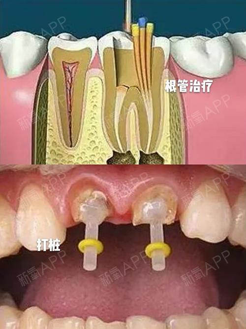 牙根管治疗是啥意思