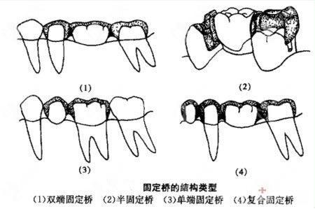 种植牙固定桥戴牙步骤