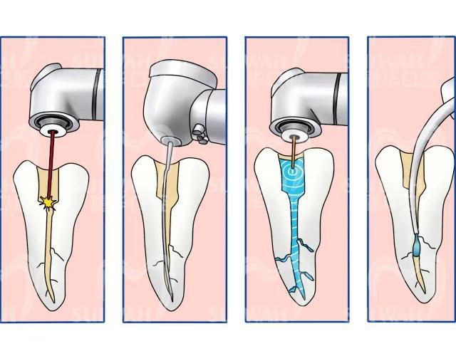牙根管治疗是啥意思