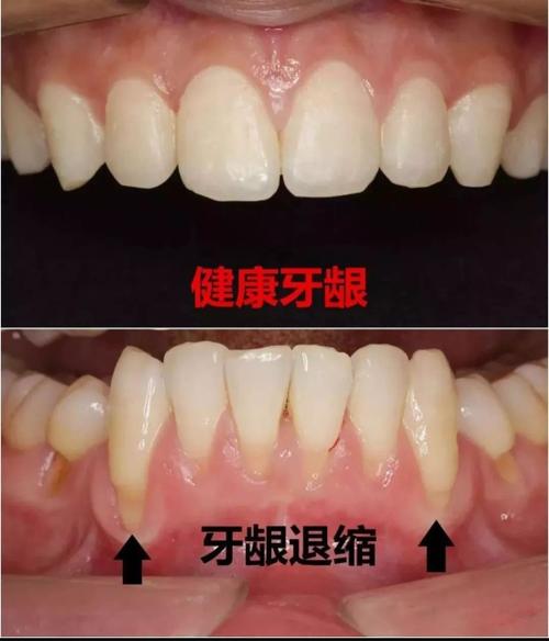 黑三角补牙龈膜龈手术副作用—黑三角补牙手术