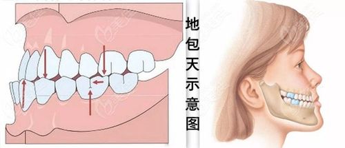 牙齿反颌，如何纠正