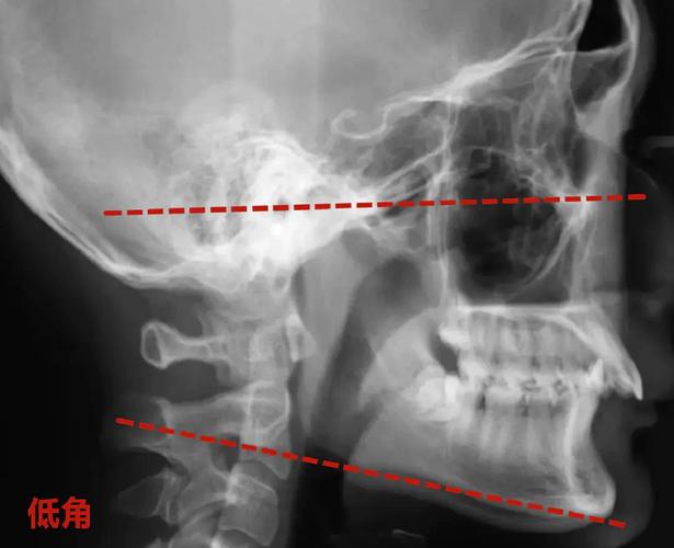 骨性前突深覆合