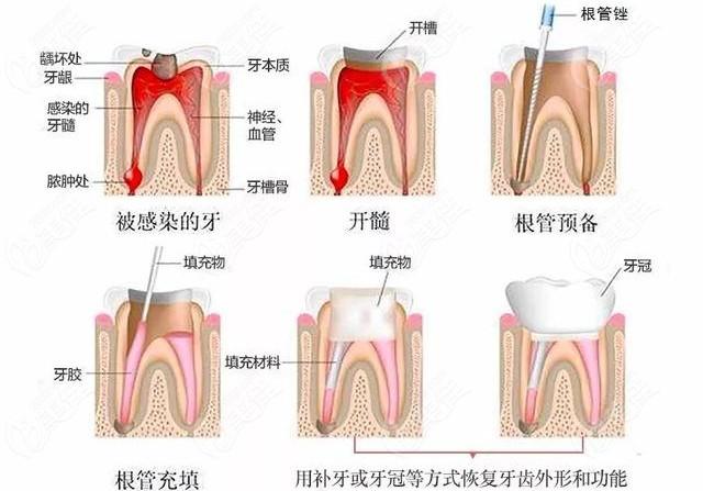 牙根管治疗是啥意思