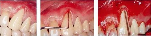 牙周袋怎么去除小窍门—牙周袋去除小窍门