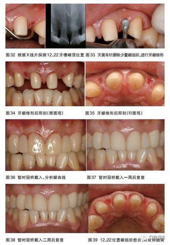 种植牙固定桥戴牙步骤