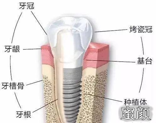种植牙愈合基台和永久基台的区别—种植牙