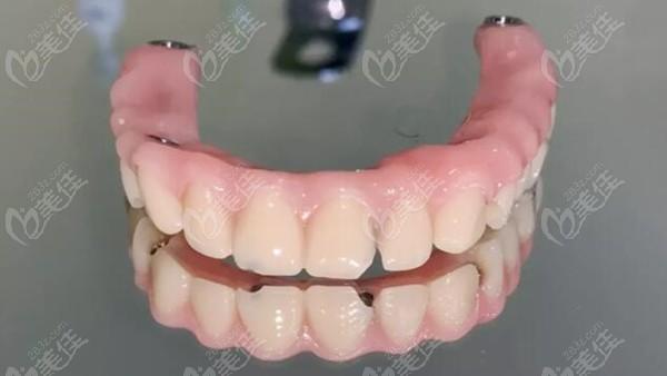 种植牙半口桥架