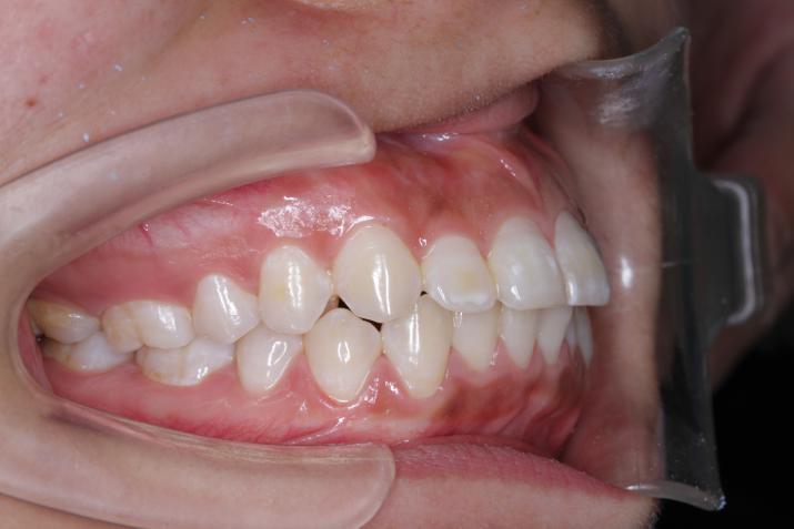 矫正牙齿弓不正的危害