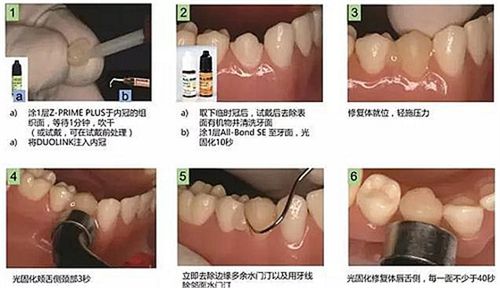 烤瓷牙树脂水门汀粘结剂怎么用